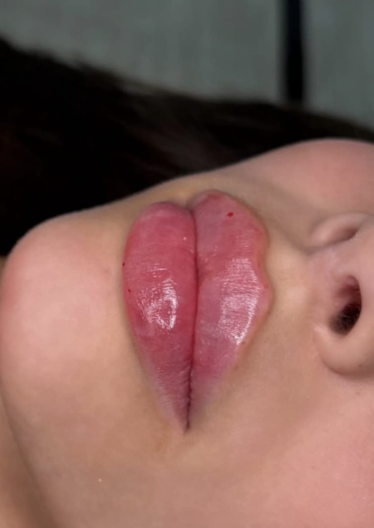 Full, glossy lips straight after a lip filler treatment at Serra Aesthetics