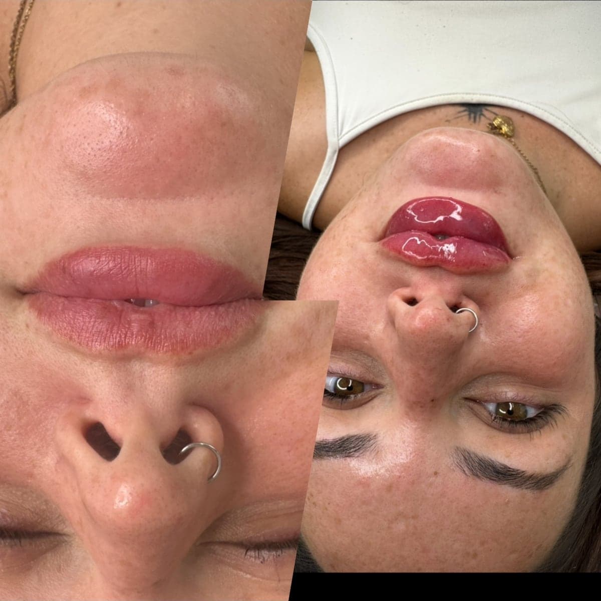 Lip filler before and after, showing fuller, defined lips