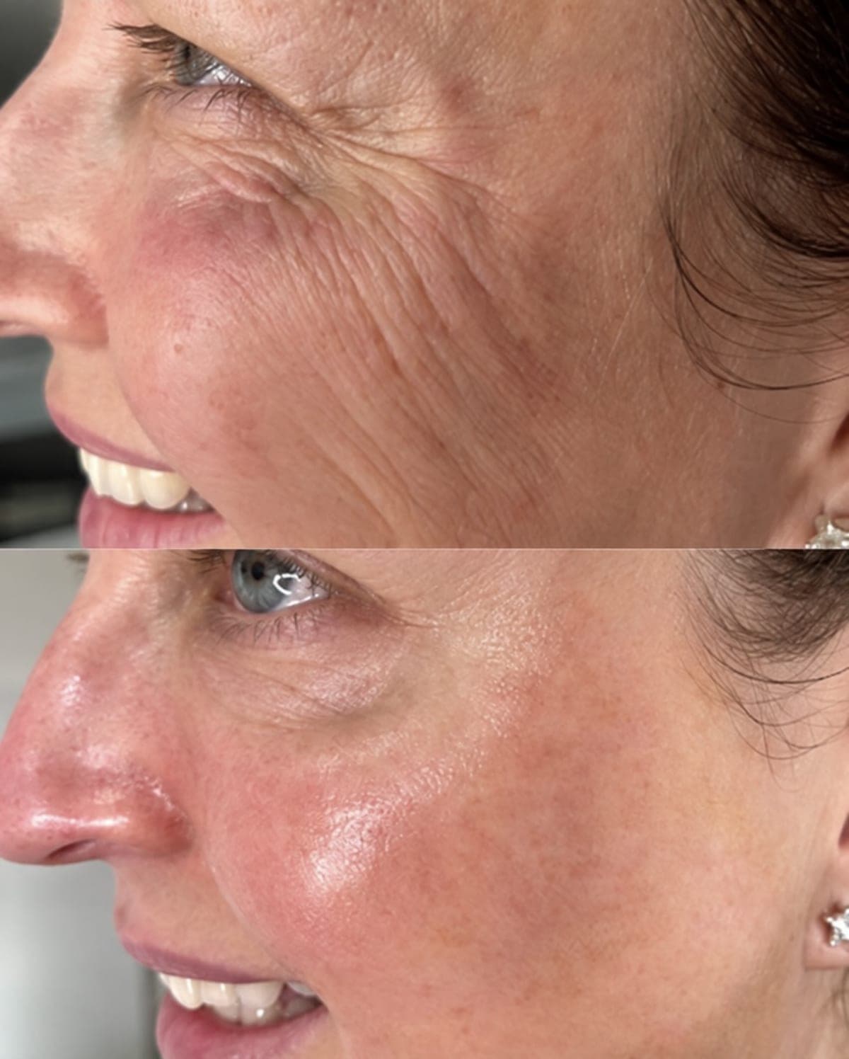 Skin booster before and after: smoother, more hydrated skin around the eye and cheek